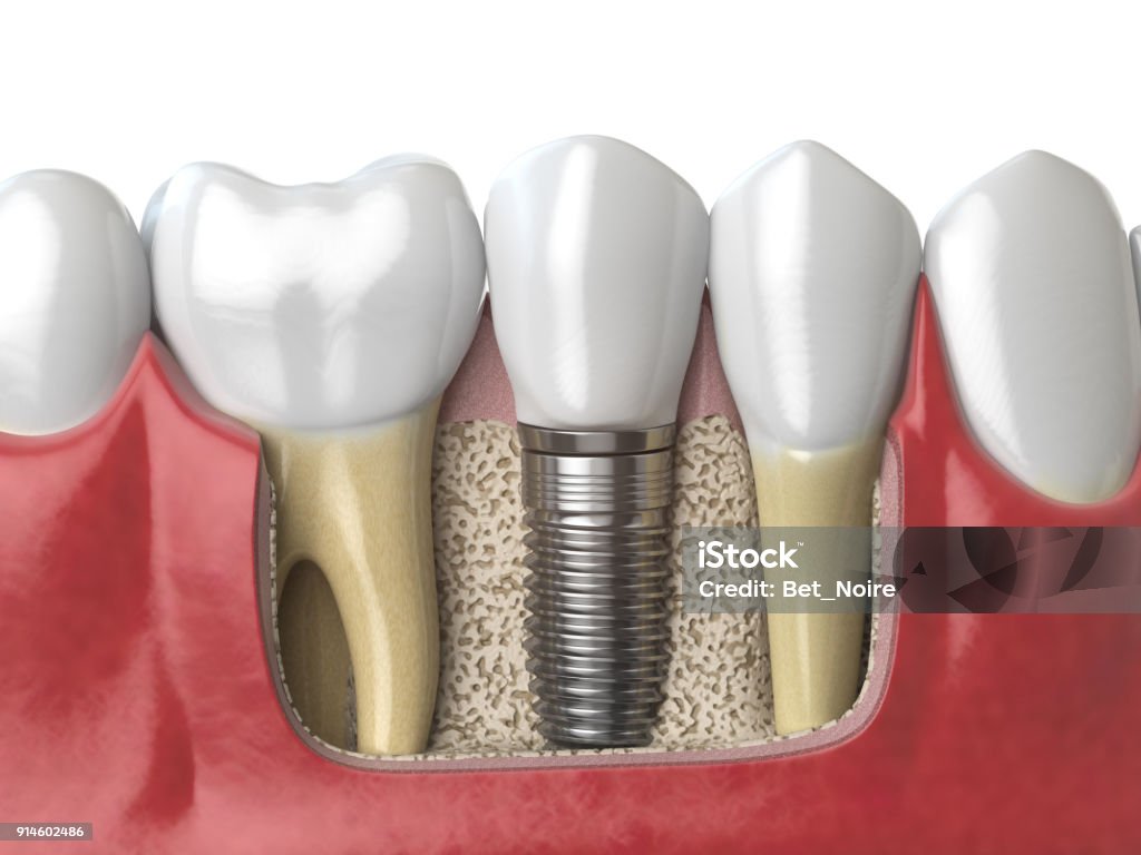 Anatomie des gesunden Zähne und Zahn Zahnimplantat in menschlichen Dentura. - Lizenzfrei Zahnimplantat Stock-Foto