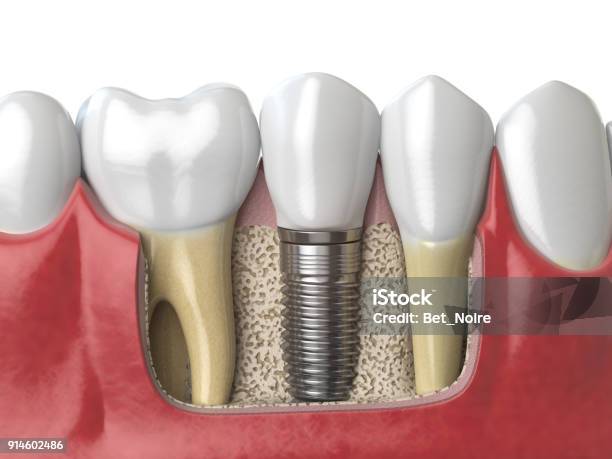 Anatomie Des Gesunden Zähne Und Zahn Zahnimplantat In Menschlichen Dentura Stockfoto und mehr Bilder von Zahnimplantat