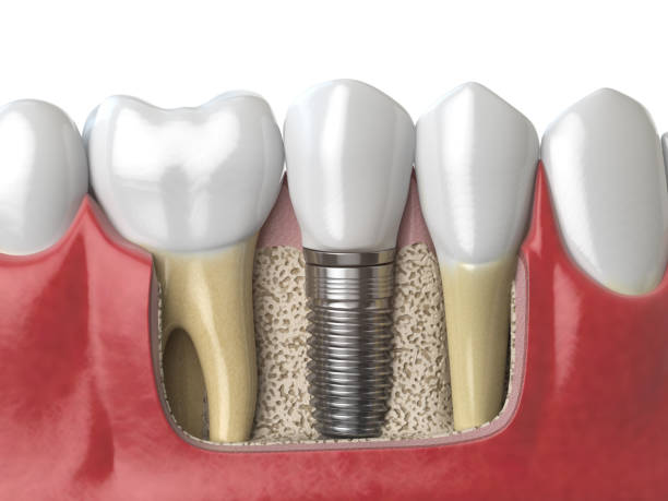 anatomía de los dientes sanos y dientes implantes dentales en humano dentura. - artificial metal healthcare and medicine technology fotografías e imágenes de stock