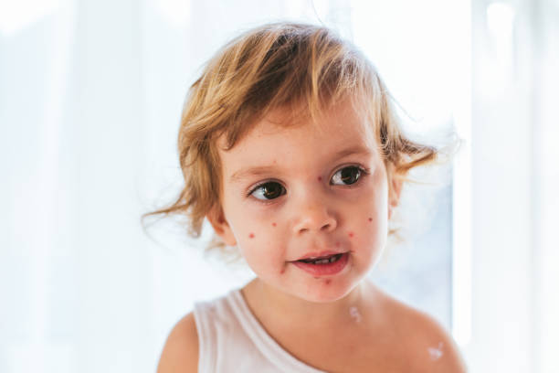 istock Varicella virus on child 914651738