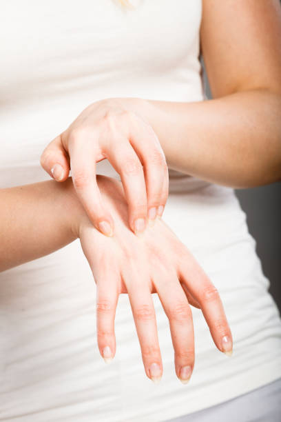 istock female scratching her itchy palm with allergy rash 914779972