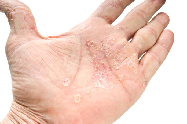 istock Psoriasis, skin disease 914962292