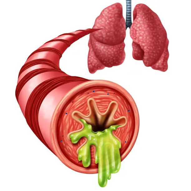 Bronchitis anatomy concept as an inflammation of bronchial tube lining with thick mucus secreted as a chest cold as a 3D illustration elements.