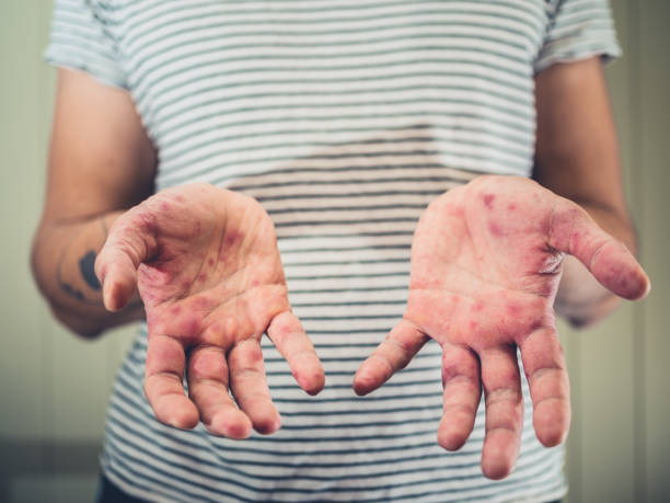 Young man with hand foot and mouth disease A young man is showing his hands with spots and rash from hand foot and mouth disease hand foot and mouth disease stock pictures, royalty-free photos & images