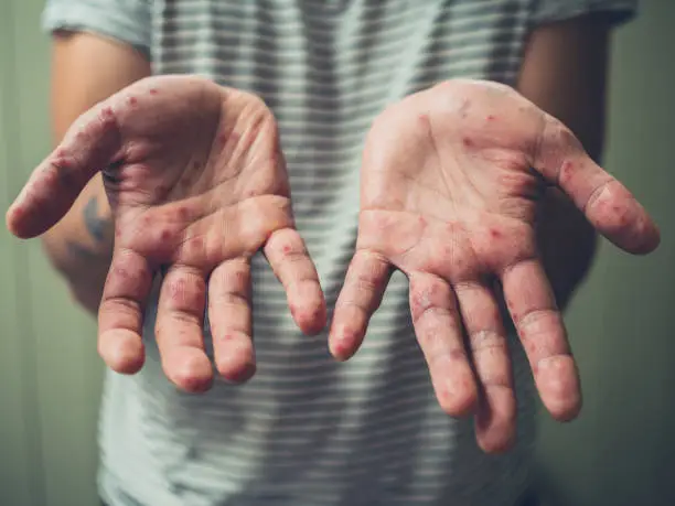 A young man is showing his hands with spots and rash from hand foot and mouth disease