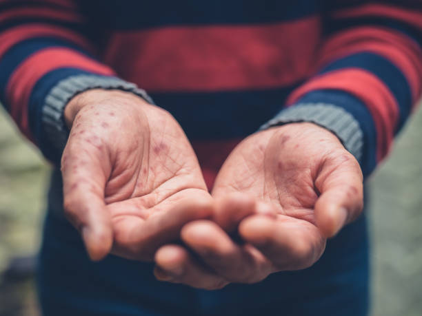 Close up on a man with spots on hands begging Close up on the hands of a young man with a rash on his hands begging outside hand foot and mouth disease stock pictures, royalty-free photos & images