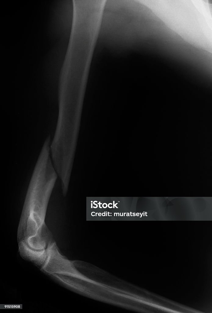 broken arm - Lizenzfrei Armknochen Stock-Foto