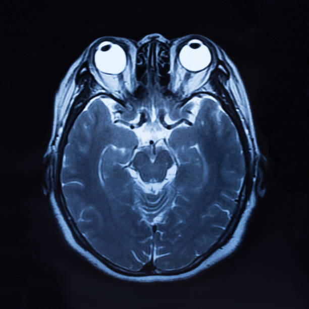 mri skan ludzkiej głowy flim - brain physical injury x ray image x ray zdjęcia i obrazy z banku zdjęć