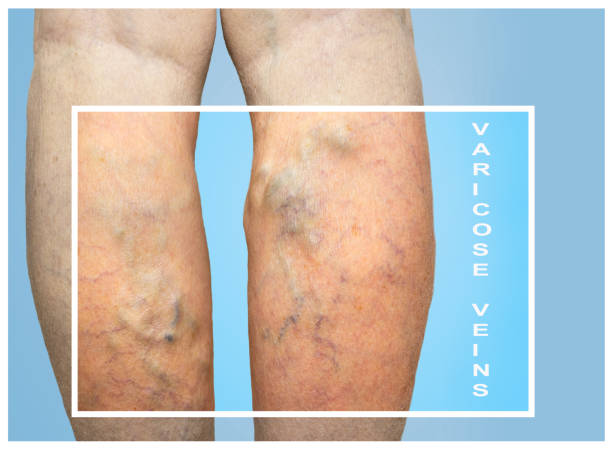 Varicose veins on a female legs The varicose veins on female legs on blue background varicose vein stock pictures, royalty-free photos & images