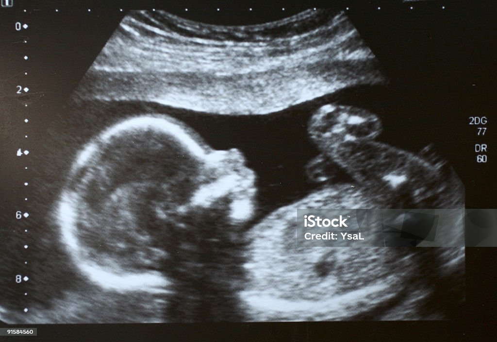 Foetus ultrasound  Ultrasound Stock Photo