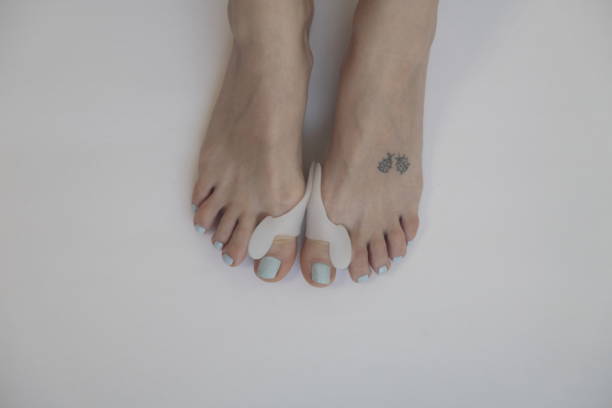 istock Hallux valgus. Gel bunion toe spreader. 915910468