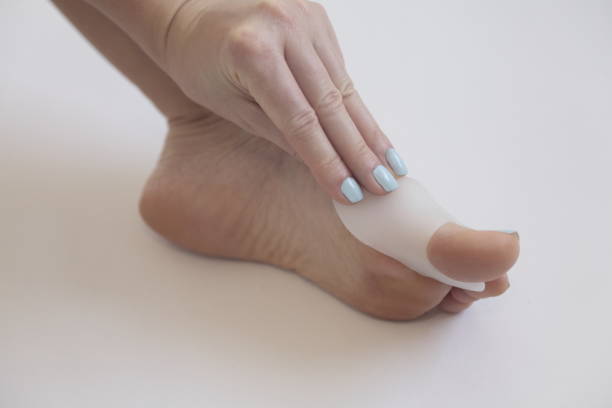 istock Hallux valgus. Gel bunion toe spreader. 915915152