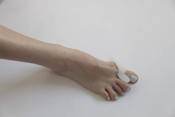 hallux valgus. spargitore di teta di gel bunion. - human foot bunion pain human toe foto e immagini stock