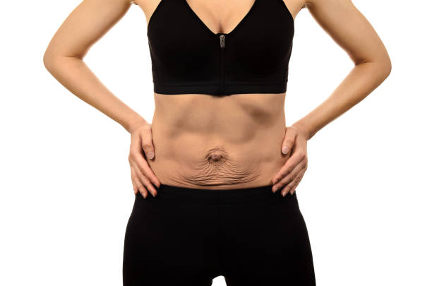 diástasis de rectos. divergencia de abdomen de la mujer de los músculos del abdomen después del embarazo y parto. piel flácida en el abdomen. - belly button fotografías e imágenes de stock