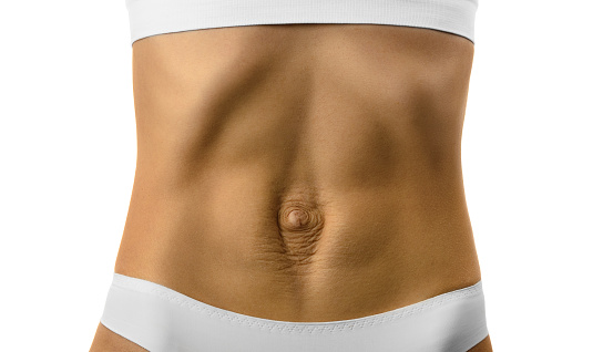 Diastasis recti. Woman's abdomen divergence of the muscles of the abdomen after pregnancy and childbirth.