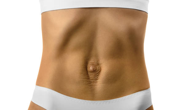 diastasis recti. woman's abdomen divergence of the muscles of the abdomen after pregnancy and childbirth. - belly button imagens e fotografias de stock