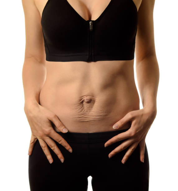 diastasis recti. woman's abdomen divergence of the muscles of the abdomen after pregnancy and childbirth. - belly button imagens e fotografias de stock