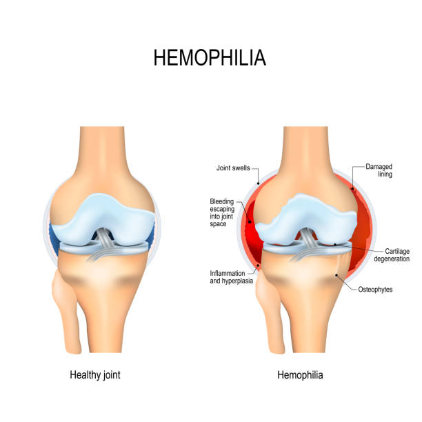 hemophilia hemophilia. Healthy kneee and joint with Haemophilia. Labeled anemia diagram stock illustrations