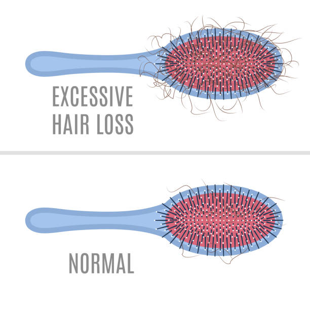 kuvapankkikuvitukset aiheesta hiusharja - normaali verrattuna hiustenlähtöön - receding hairline