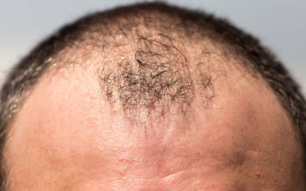 istock Bald spots on the head of a man 916790274