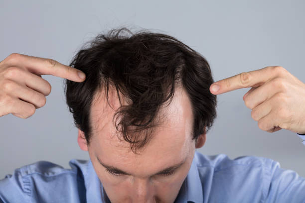 istock Man With Hair Loss Symptoms 917034488