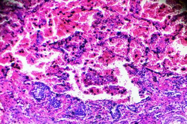 muestra de patología humana de neumonitis intersticial bajo microscopia - interstitial fotografías e imágenes de stock