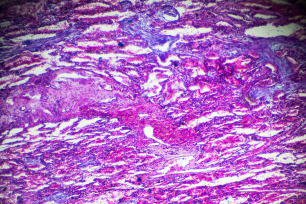 muestra de patología humana de neumonitis intersticial bajo microscopia - interstitial fotografías e imágenes de stock