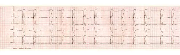 ECG tape with pacemaker arrhythmia (ventricular stimulation)