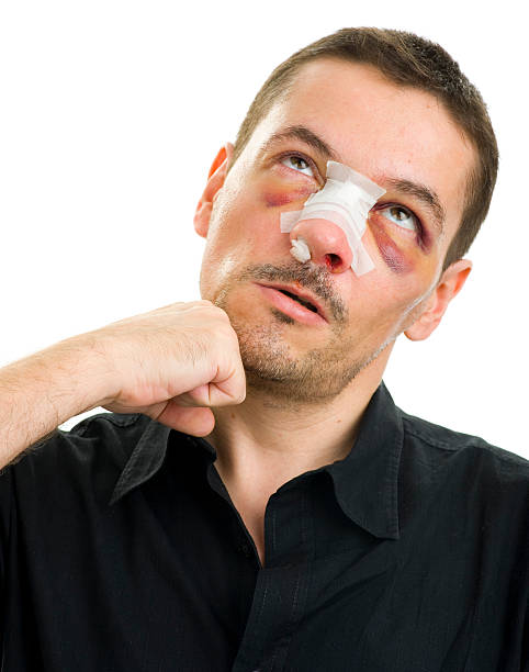 broken-nose-and-black-eyes-