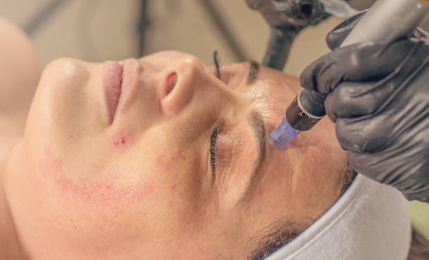 Needle mesotherapy treatment on a woman face. Needle mesotherapy treatment on a woman face. microneedling for fine lines stock pictures, royalty-free photos & images Needle mesotherapy treatment on a woman face. Needle mesotherapy treatment on a woman face. microneedling for fine lines stock pictures, royalty-free photos & images