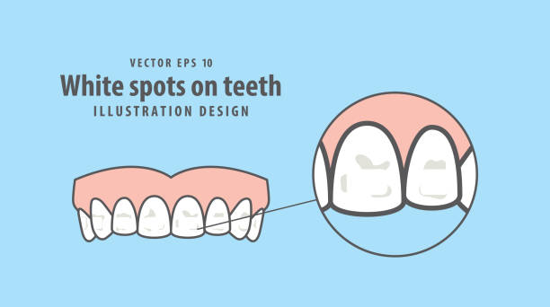 weiße flecken auf zähnen illustration vektor auf blauem hintergrund. dental konzept. - spotting stock-grafiken, -clipart, -cartoons und -symbole