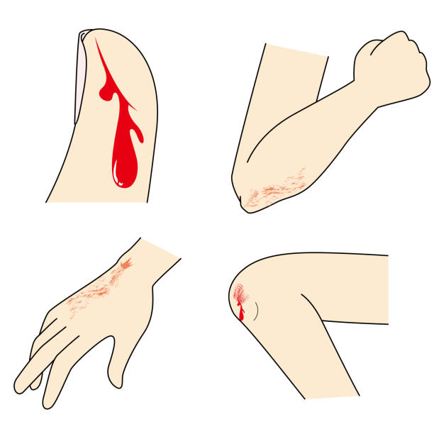 ilustrações de stock, clip art, desenhos animados e ícones de hand and foot injuries - wound blood human finger human hand