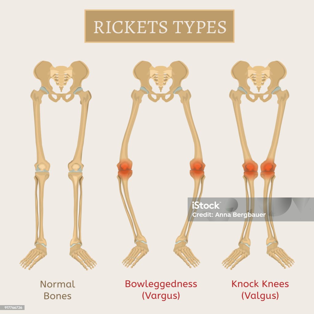 Vector Rickets Scheme Normal bones versus Rickets and Osteomalacia. Types of disease. Medical, anatomy and biology concept. Educational vector illustration isolated on a white background. Knobbly Knees stock vector