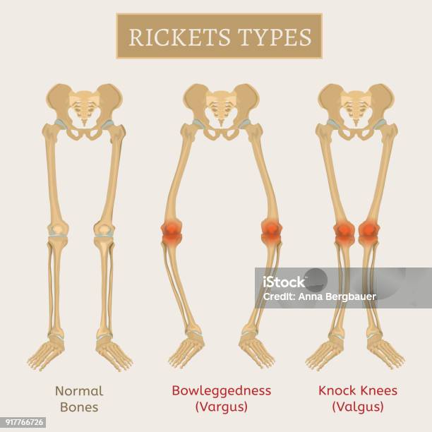 Vector Rickets Scheme Stock Illustration - Download Image Now - Knobbly Knees, Knee, Illustration