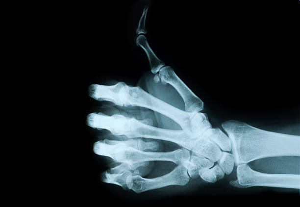 X-ray view of hand giving no a thumbs up stock photo