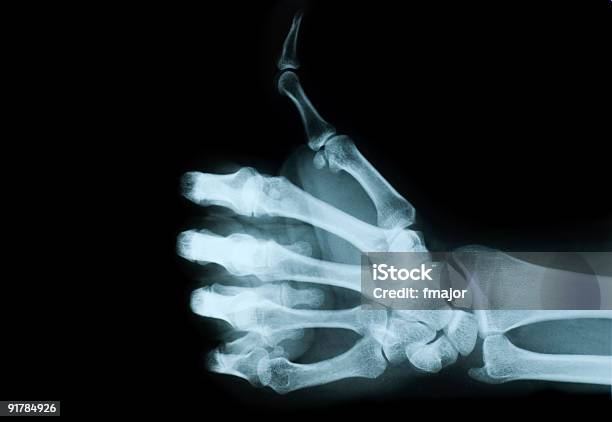 Xray View Of Hand Giving No A Thumbs Up Stock Photo - Download Image Now - X-ray Image, Medical X-ray, Thumbs Up
