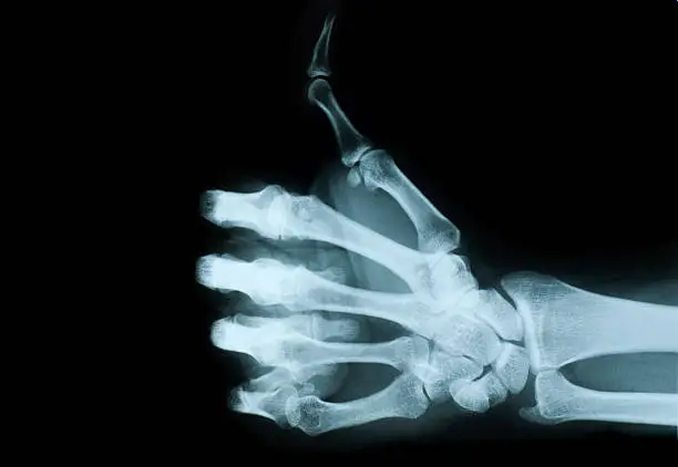 Photo of X-ray view of hand giving no a thumbs up