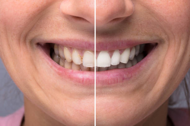 istock Person Teeth Before And After Whitening 917893044