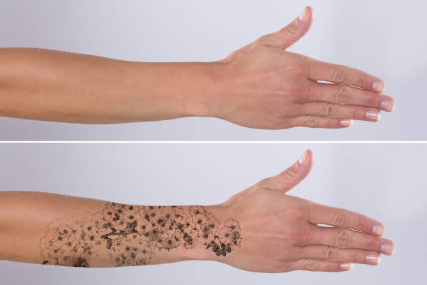 istock Laser Tattoo Removal On Woman's Hand 917893092