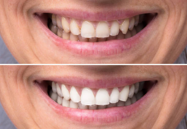 istock Person Teeth Before And After Whitening 917893094
