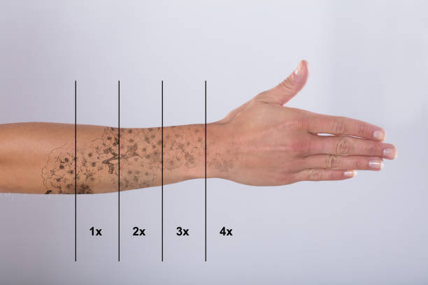 istock Laser Tattoo Removal On Woman's Hand 917893102