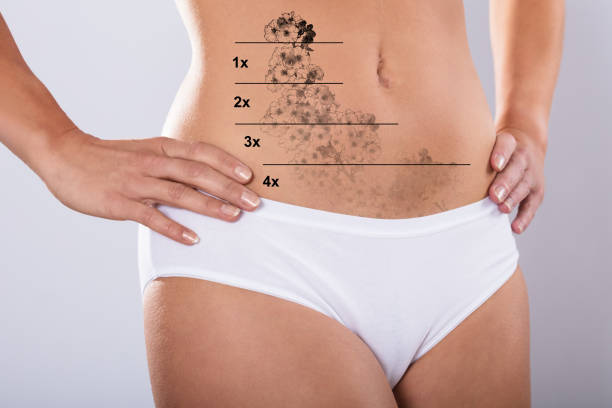 Close-up Of A Laser Tattoo Removal On Woman's Stomach