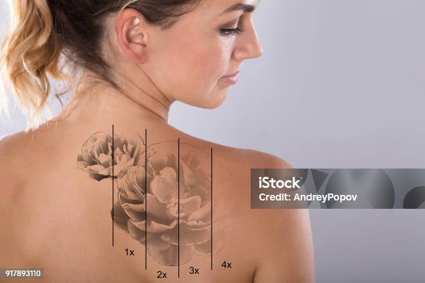 Laser Tattooentfernung Auf Frau Schulter Stockfoto und mehr Bilder von Tätowierung - Tätowierung, Entfernen, Laserlicht