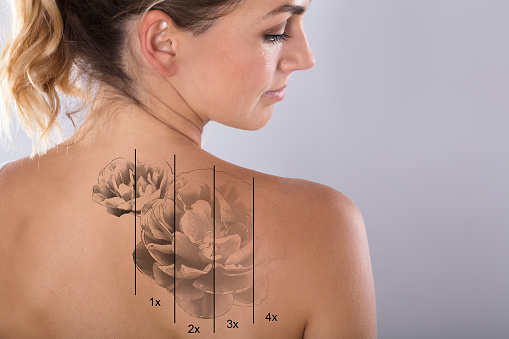 Láser eliminación de tatuajes en el hombro de la mujer photo