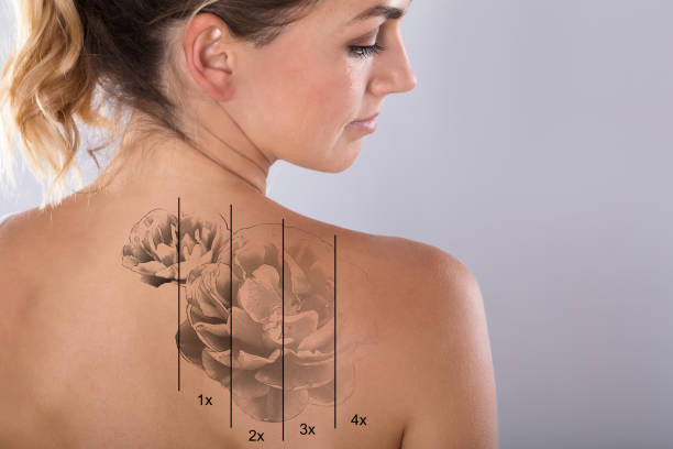 Laser Tattoo Removal On Woman's Shoulder Laser Tattoo Removal On Woman's Shoulder Against Gray Background removing stock pictures, royalty-free photos & images
