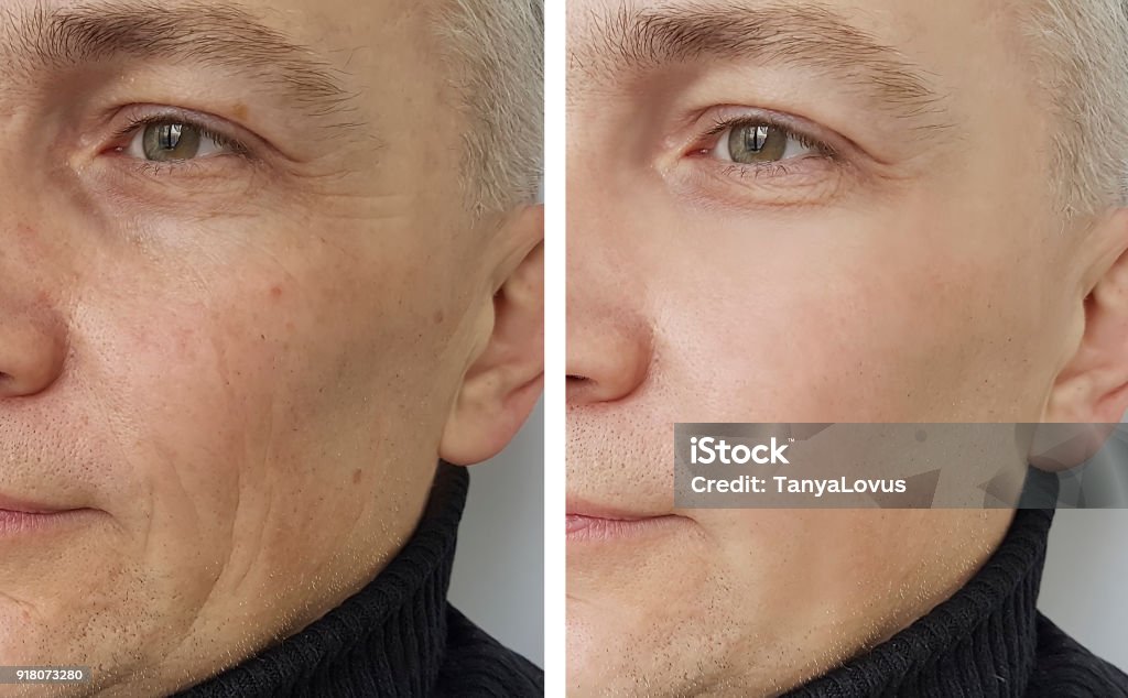man wrinkles before and after Botulinum Toxin Injection Stock Photo