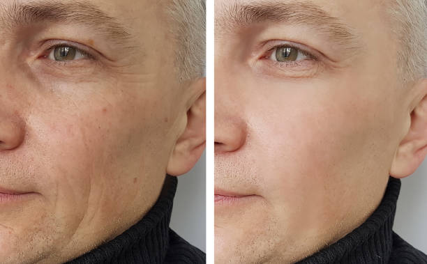 man wrinkles before and after man wrinkles before and after botox before and after stock pictures, royalty-free photos & images
