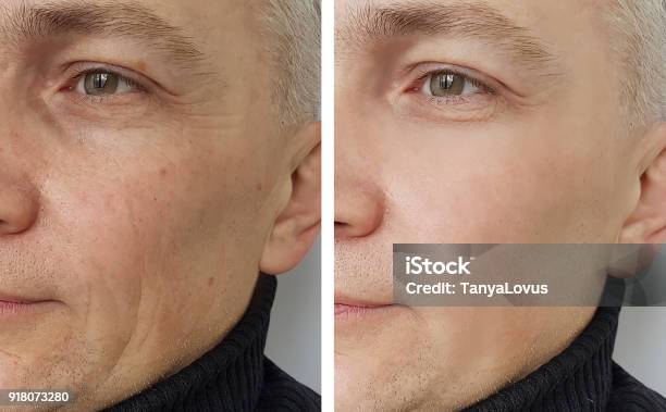Man Wrinkles Before And After Stock Photo - Download Image Now - Botulinum Toxin Injection, Men, Anticipation