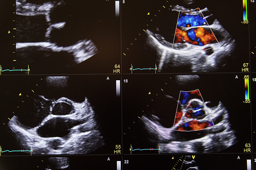 Heart ultrasound image on a computer screen.