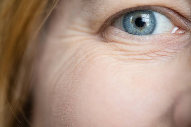 istock Close-Up of Woman's Eye Wrinkles 918117640